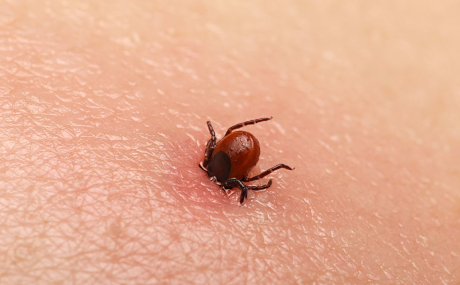 Zecken können den FSME-Virus übertragen. Das Amt für Gesundheit und Gefahrenabwehr des Main-Kinzig-Kreises empfiehlt zum Schutz eine Impfung.